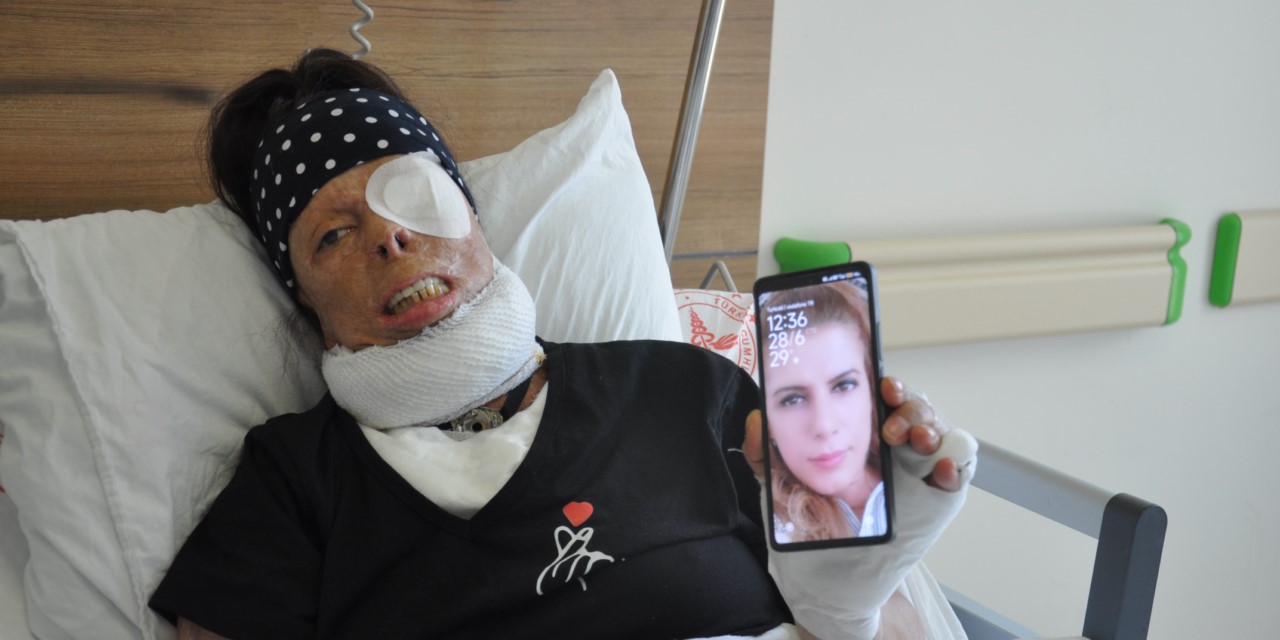 Kezzap saldırısında ağır yaralanmıştı, yeniden hayata tutunmaya çalışıyor