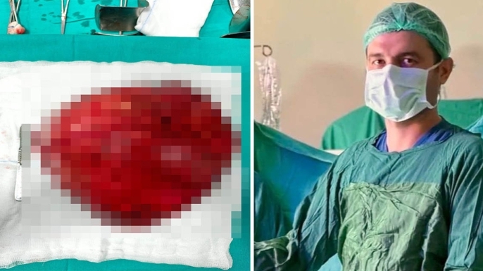 Akşehir'de görme engelli hastadan 40 santimetre büyüklüğünde kitle alındı