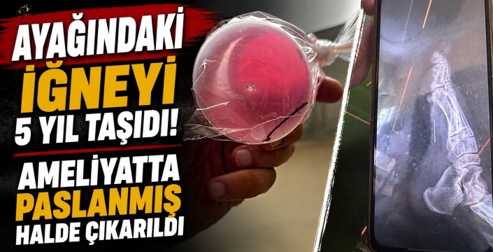 Ayağındaki iğneyi 5 yıl taşıdı! Ameliyatta paslanmış halde çıkarıldı
